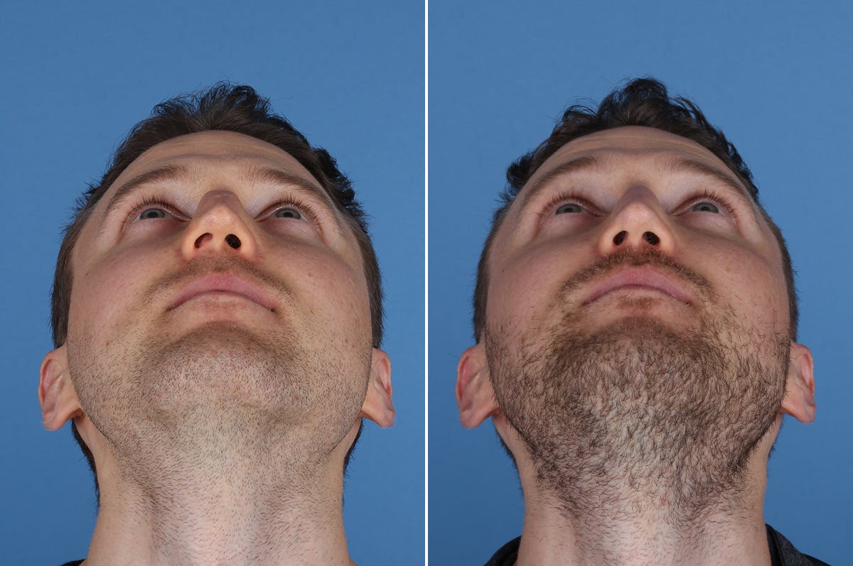Revision Rhinoplasty Before & After Gallery - Patient 169283 - Image 3