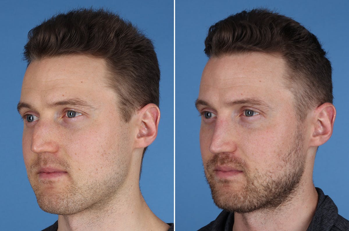 Revision Rhinoplasty Before & After Gallery - Patient 169283 - Image 4