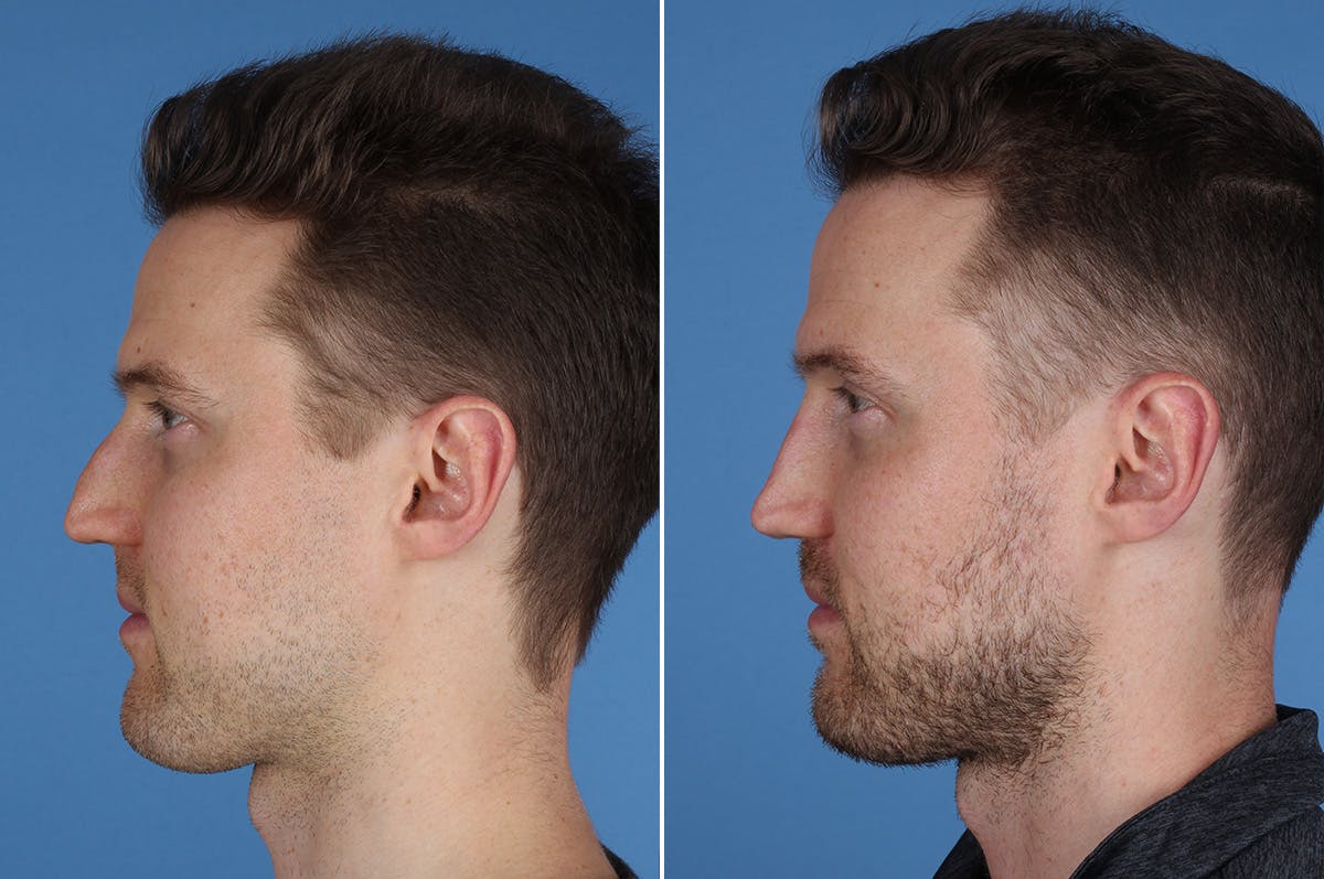 Revision Rhinoplasty Before & After Gallery - Patient 169283 - Image 5