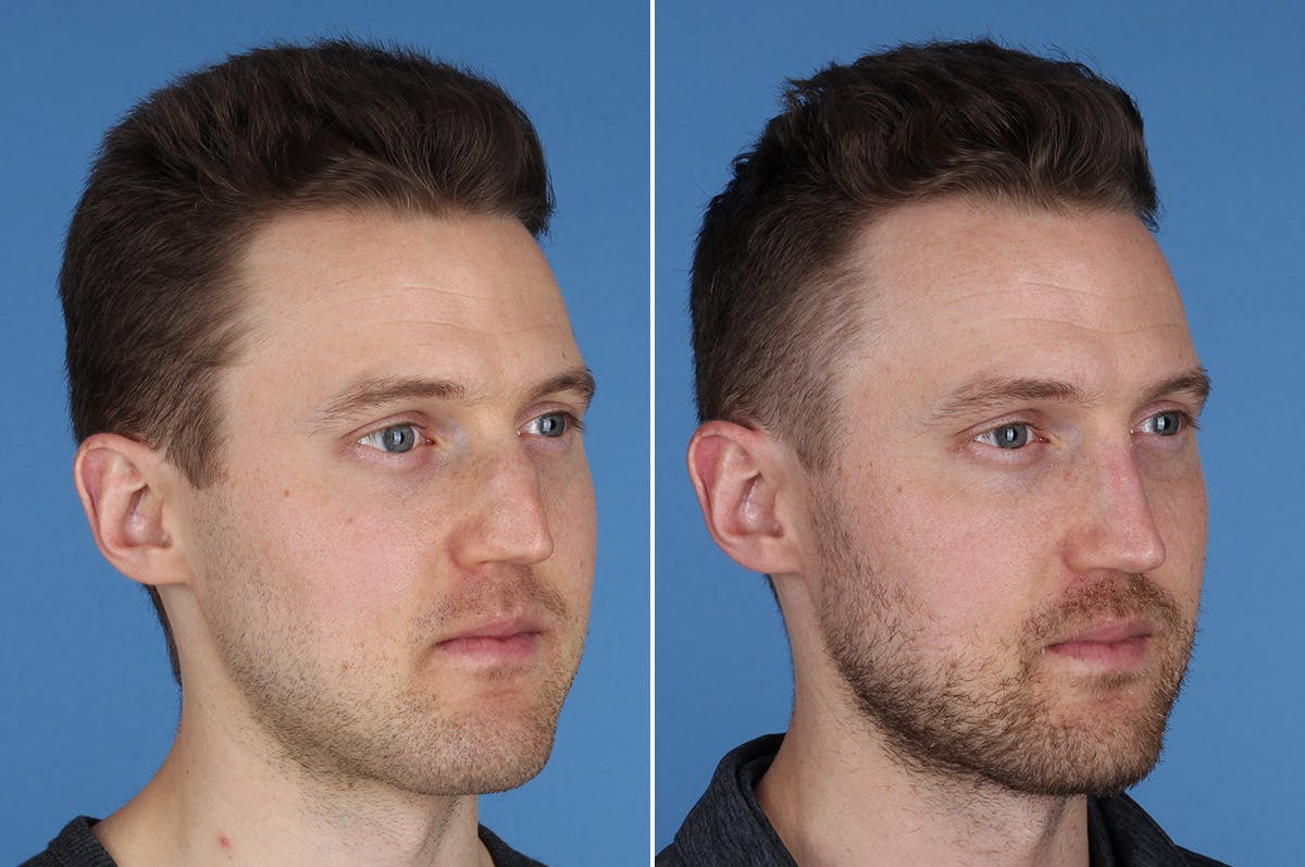 Revision Rhinoplasty Before & After Gallery - Patient 169283 - Image 7