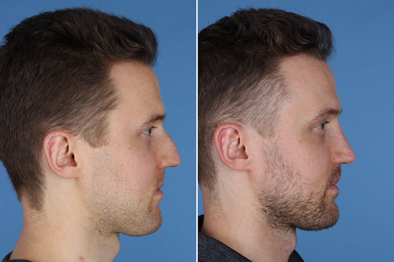 Revision Rhinoplasty Before & After Gallery - Patient 169283 - Image 1
