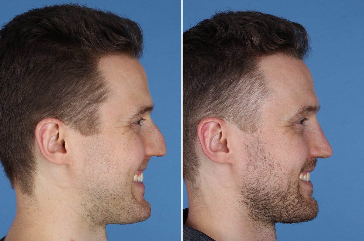 Revision Rhinoplasty Before & After Gallery - Patient 169283 - Image 8