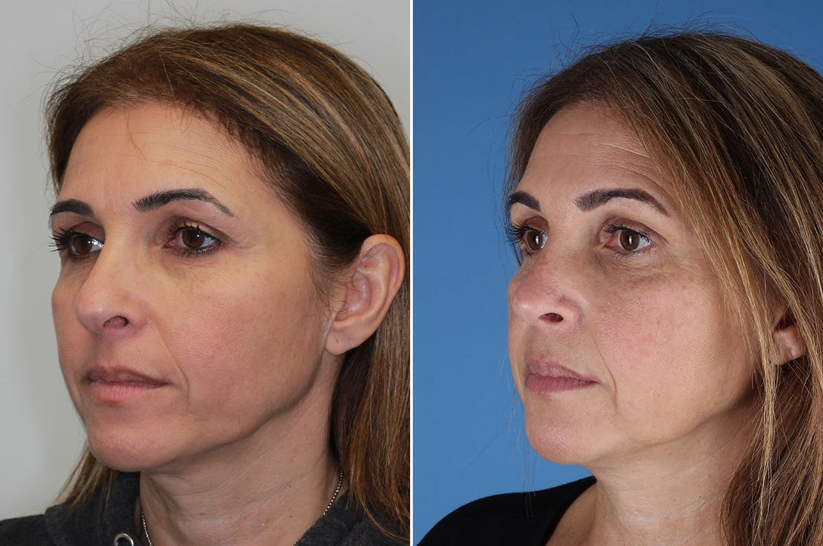 Revision Rhinoplasty Before & After Gallery - Patient 517954 - Image 2
