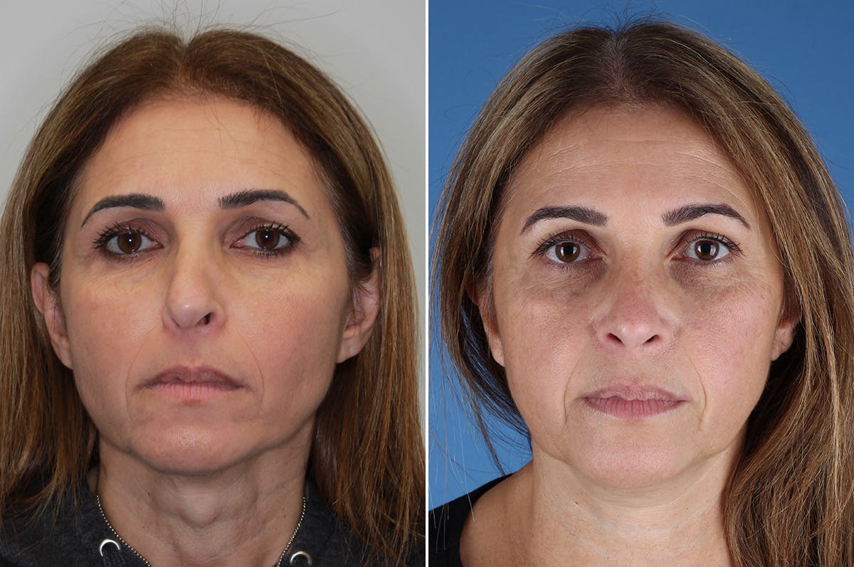 Revision Rhinoplasty Before & After Gallery - Patient 517954 - Image 3