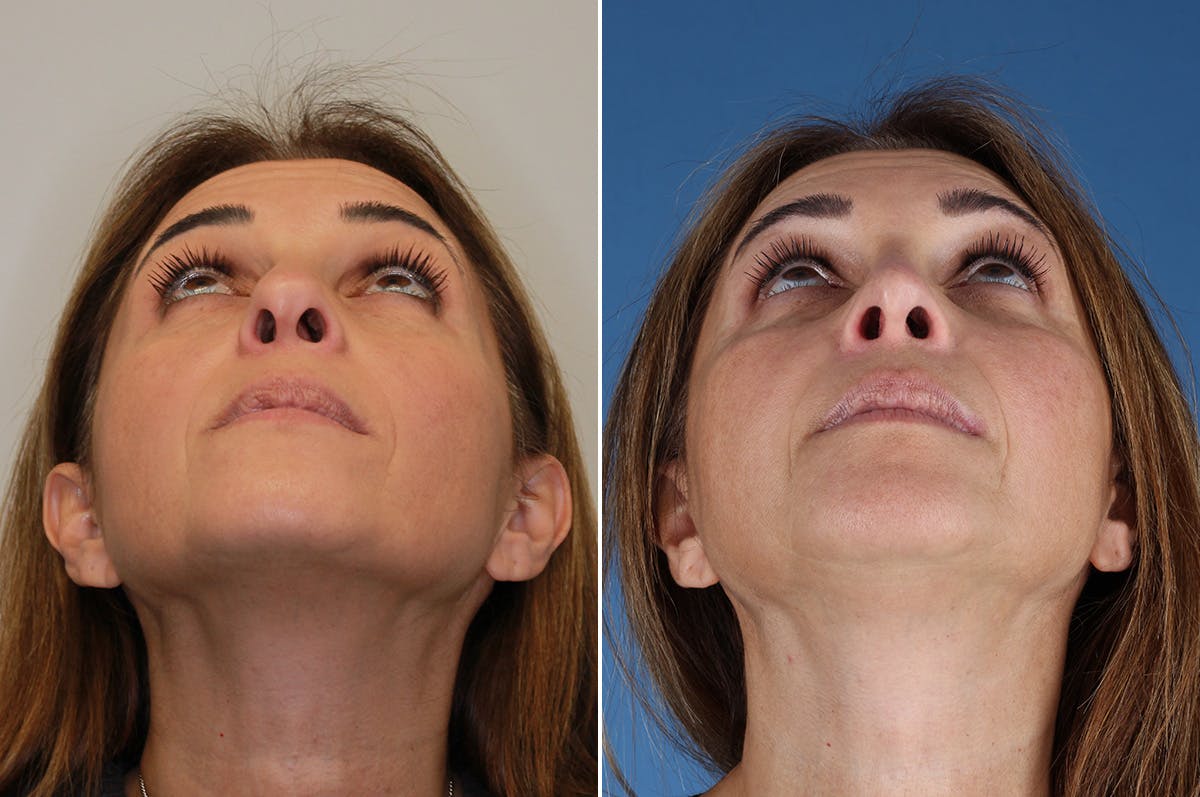 Revision Rhinoplasty Before & After Gallery - Patient 517954 - Image 4