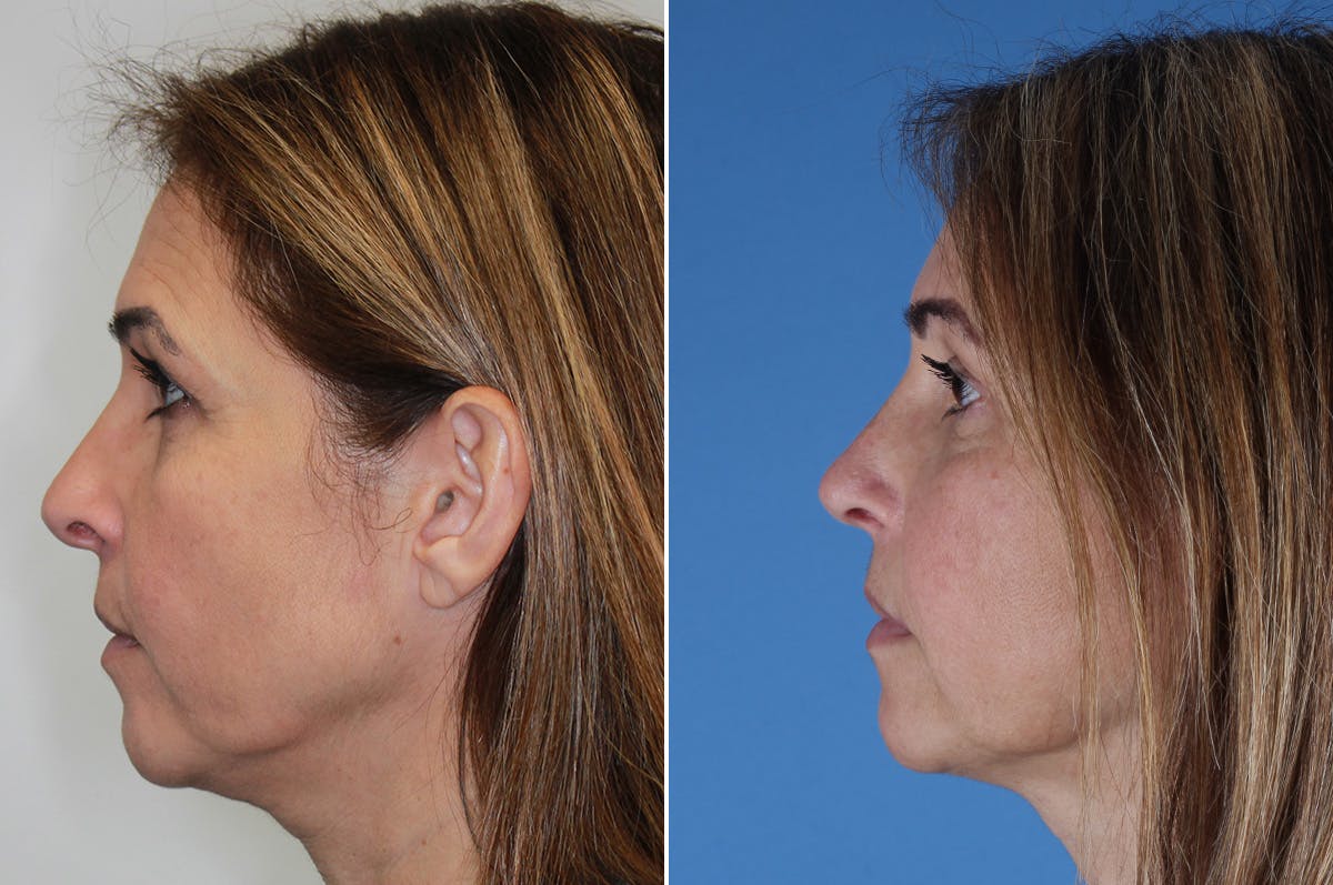 Revision Rhinoplasty Before & After Gallery - Patient 517954 - Image 5