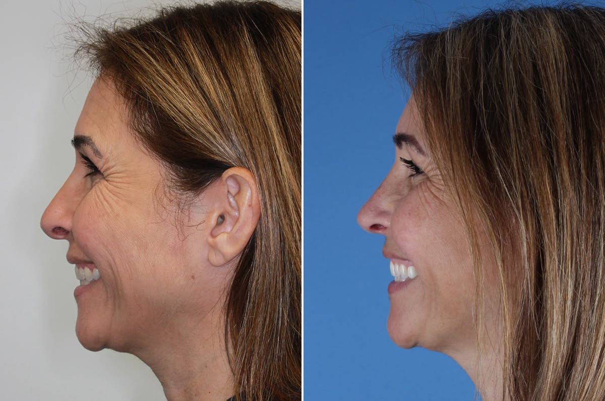Revision Rhinoplasty Before & After Gallery - Patient 517954 - Image 6