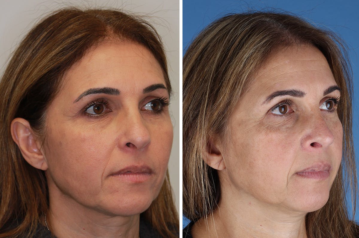 Revision Rhinoplasty Before & After Gallery - Patient 517954 - Image 7