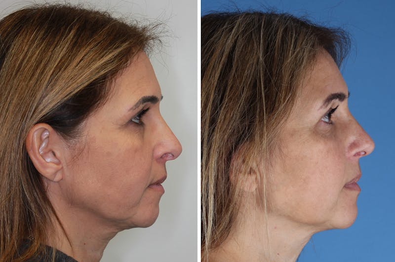 Revision Rhinoplasty Before & After Gallery - Patient 517954 - Image 1