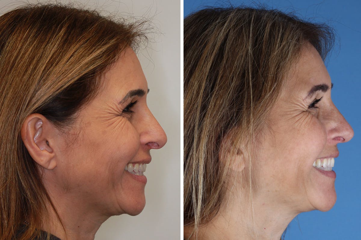 Revision Rhinoplasty Before & After Gallery - Patient 517954 - Image 8