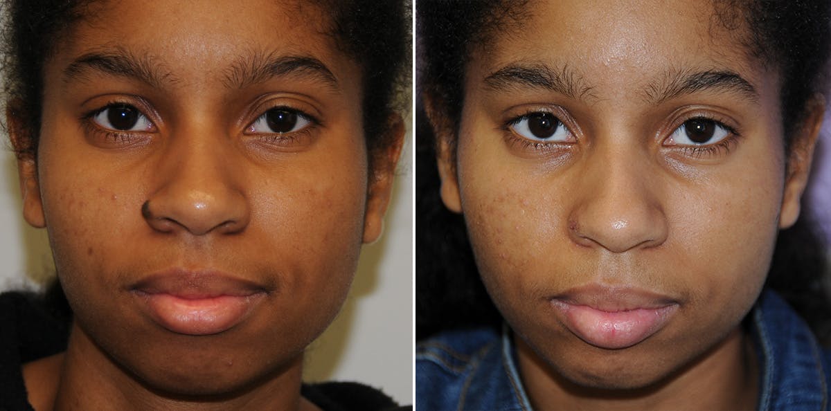 Nevi Before & After Gallery - Patient 333535 - Image 1