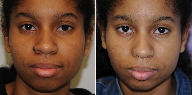 Nevi Before & After Gallery - Patient 333535 - Image 1