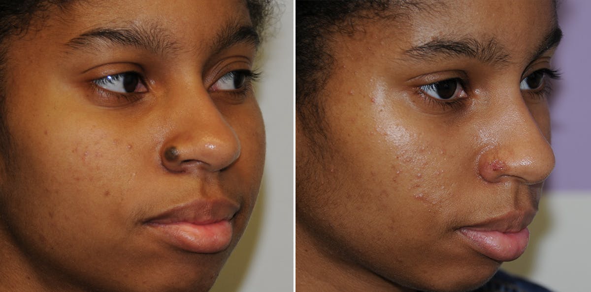 Nevi Before & After Gallery - Patient 333535 - Image 2