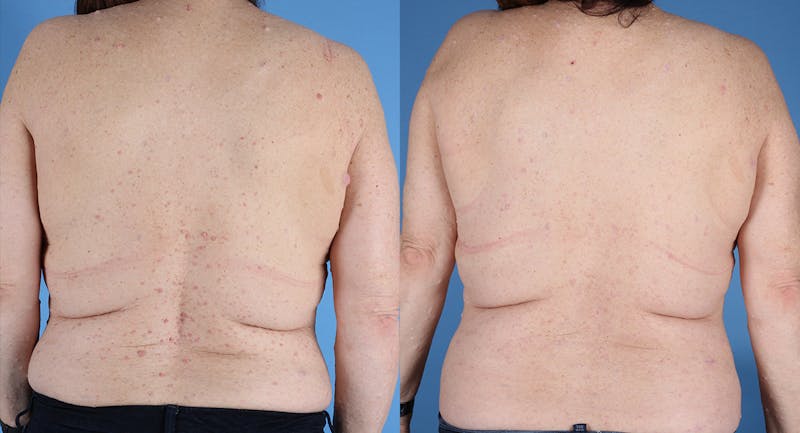 Neurofibromatosis Before & After Gallery - Patient 364648 - Image 1