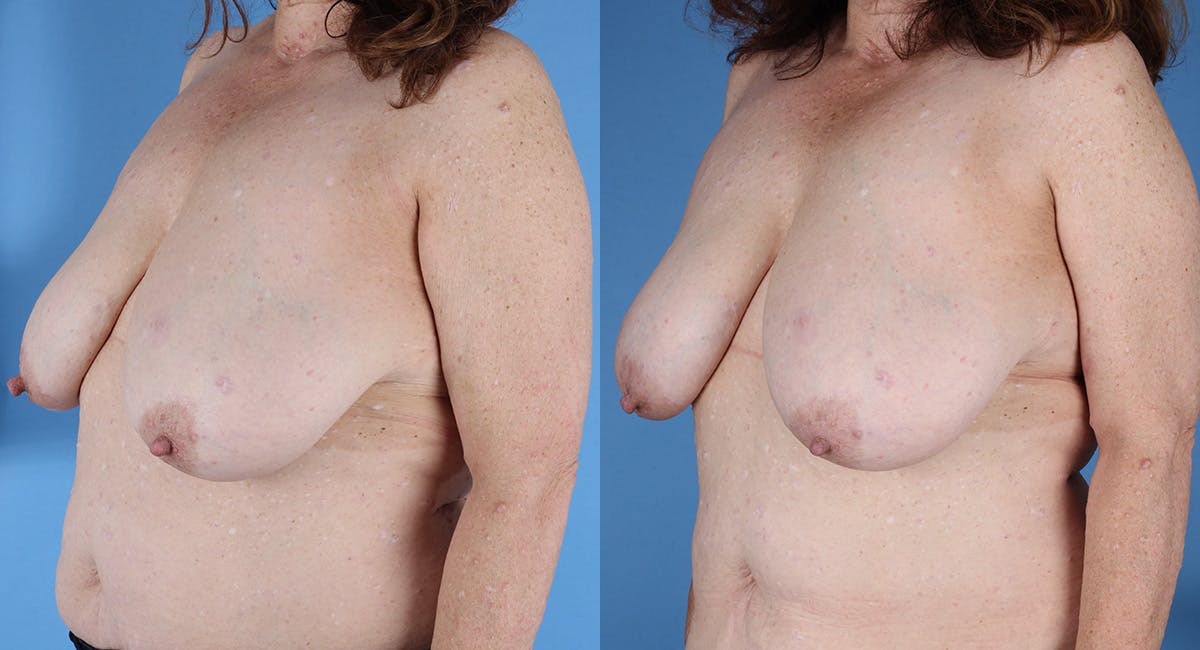 Neurofibromatosis Before & After Gallery - Patient 364648 - Image 2
