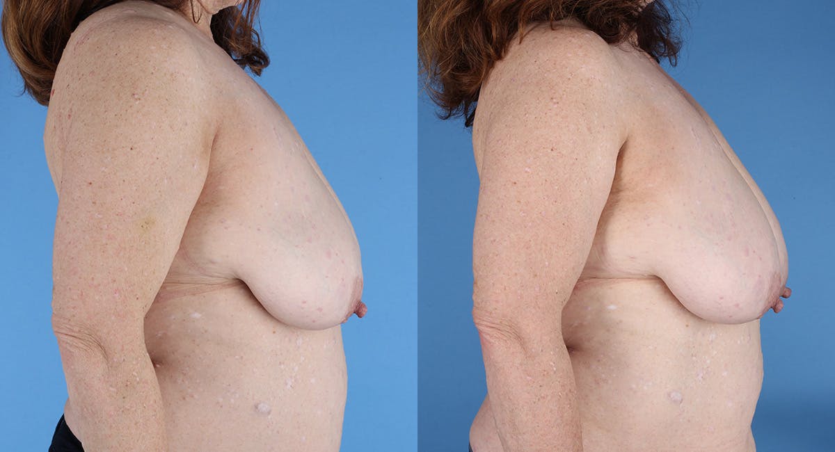 Neurofibromatosis Before & After Gallery - Patient 364648 - Image 3
