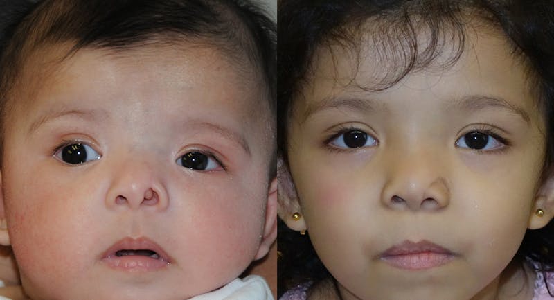 Nasal Deformity Before & After Gallery - Patient 204880 - Image 1