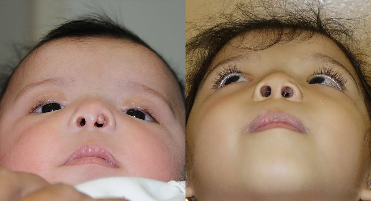 Nasal Deformity Before & After Gallery - Patient 204880 - Image 2