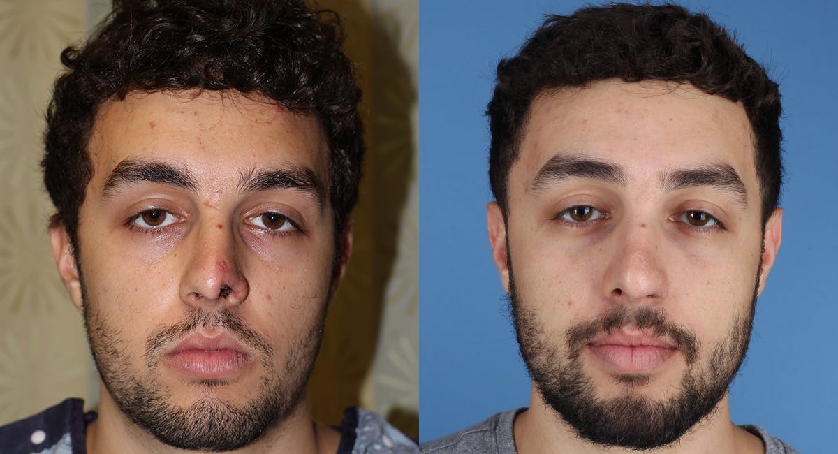 Nasal Deformity Before & After Gallery - Patient 600792 - Image 2