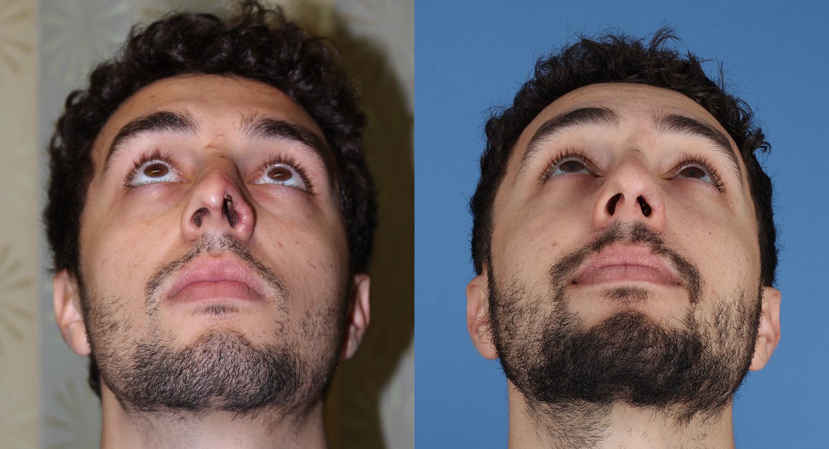 Nasal Deformity Before & After Gallery - Patient 600792 - Image 3