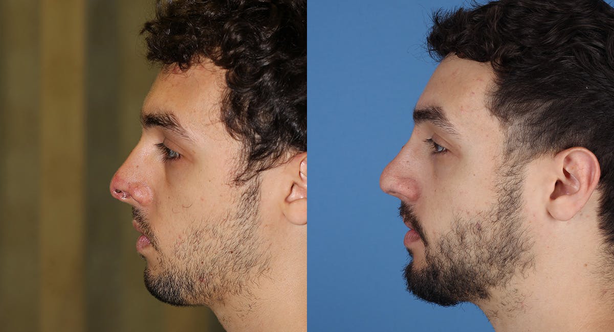 Nasal Deformity Before & After Gallery - Patient 600792 - Image 1