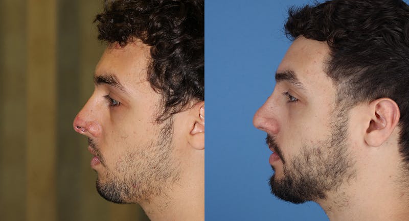 Nasal Deformity Before & After Gallery - Patient 600792 - Image 1