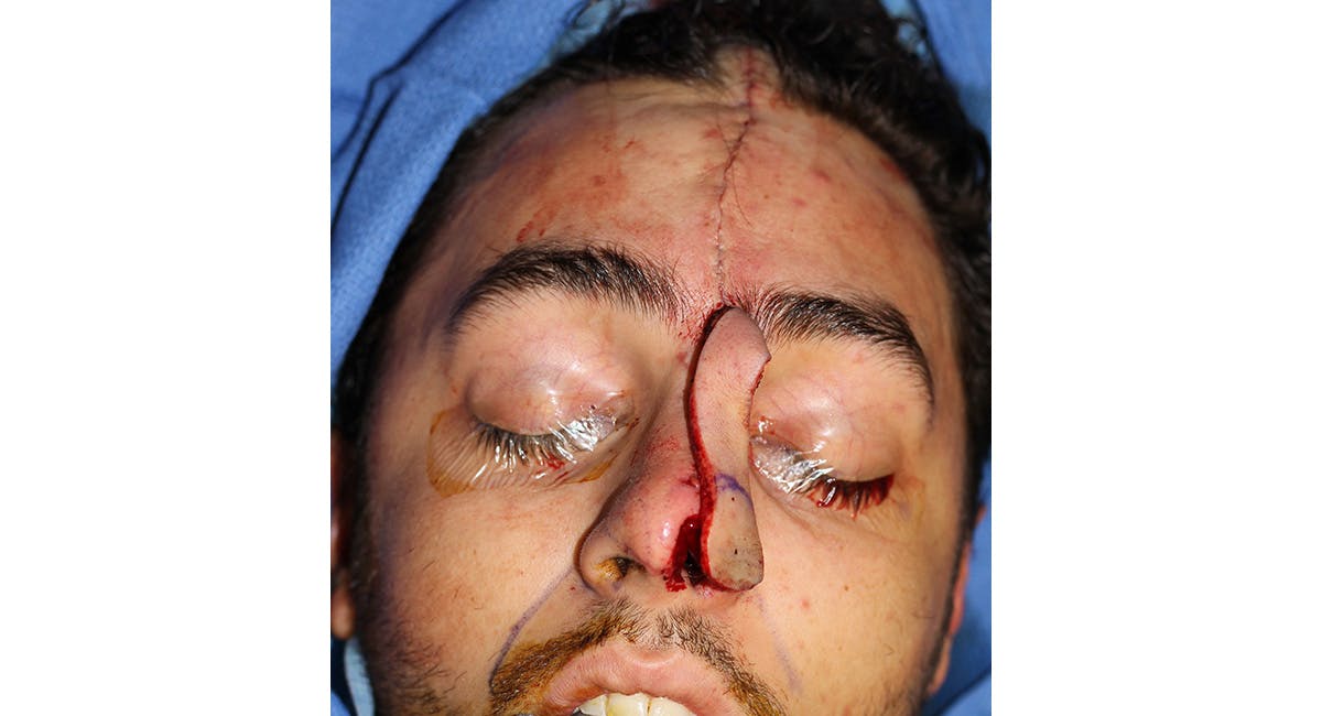 Nasal Deformity Before & After Gallery - Patient 600792 - Image 5
