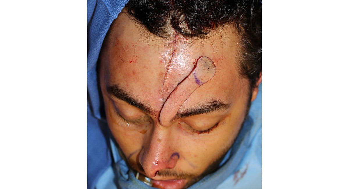 Nasal Deformity Before & After Gallery - Patient 600792 - Image 6
