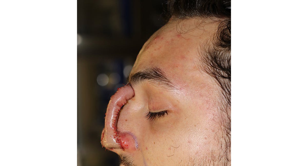 Nasal Deformity Before & After Gallery - Patient 600792 - Image 7