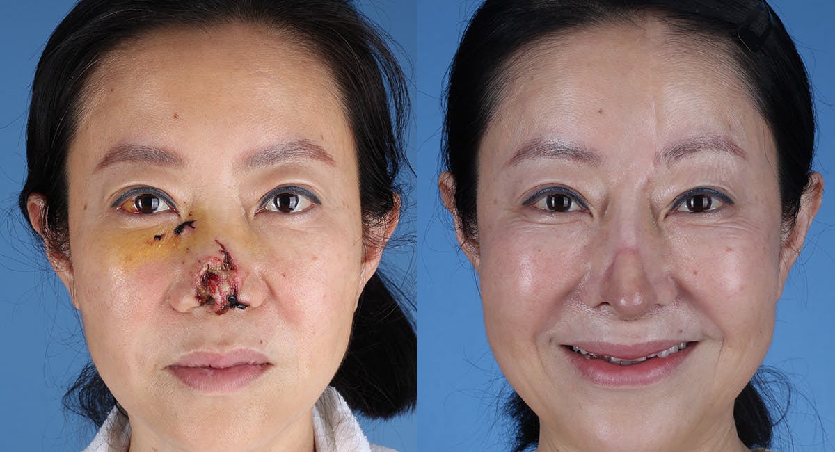 Nasal Deformity Before & After Gallery - Patient 102523 - Image 2