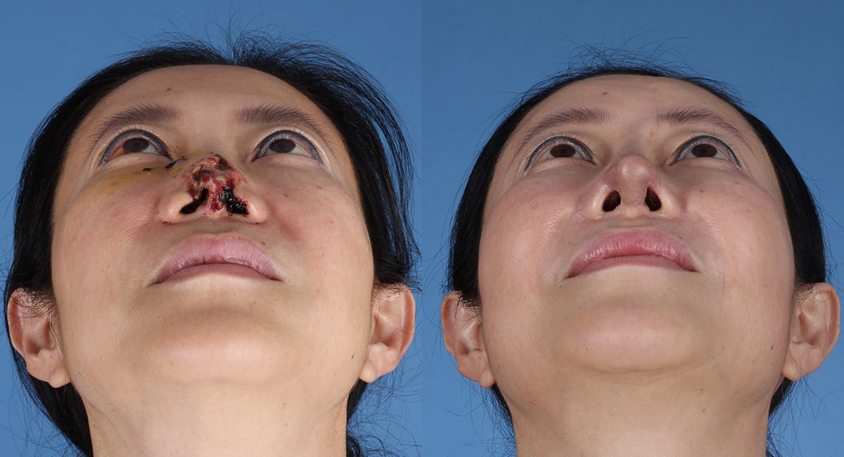 Nasal Deformity Before & After Gallery - Patient 102523 - Image 3