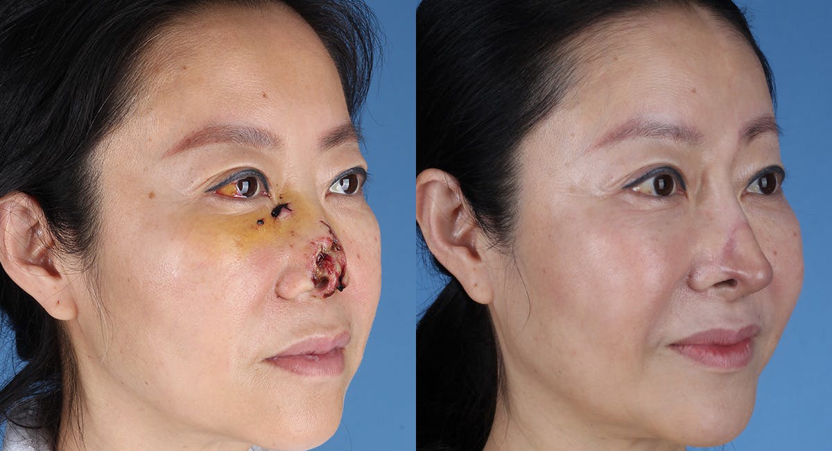 Nasal Deformity Before & After Gallery - Patient 102523 - Image 4