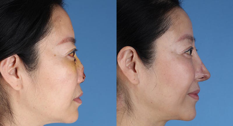Nasal Deformity Before & After Gallery - Patient 102523 - Image 1