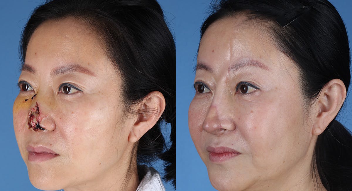 Nasal Deformity Before & After Gallery - Patient 102523 - Image 5