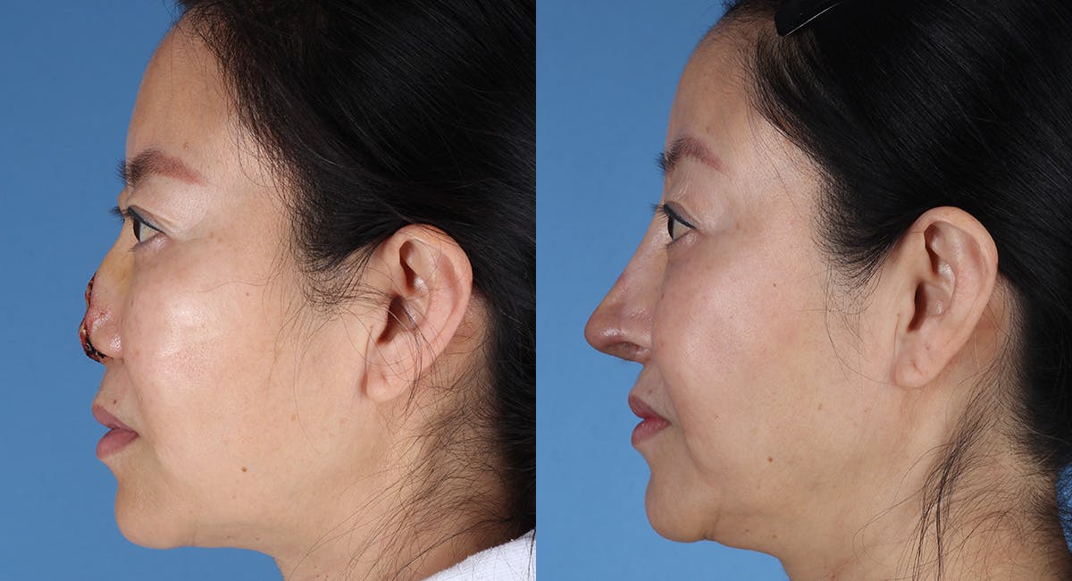 Nasal Deformity Before & After Gallery - Patient 102523 - Image 6
