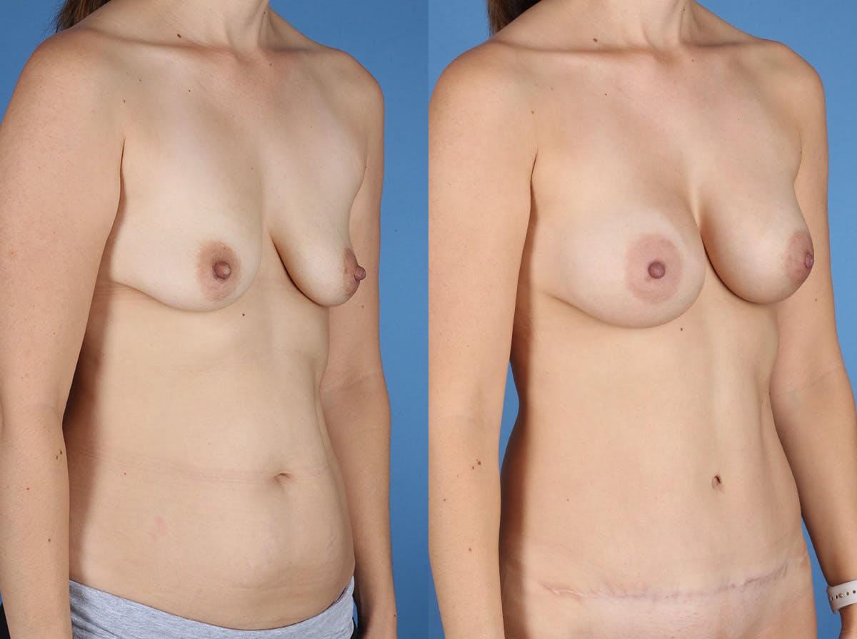 Mommy Makeover Before & After Gallery - Patient 273555 - Image 2