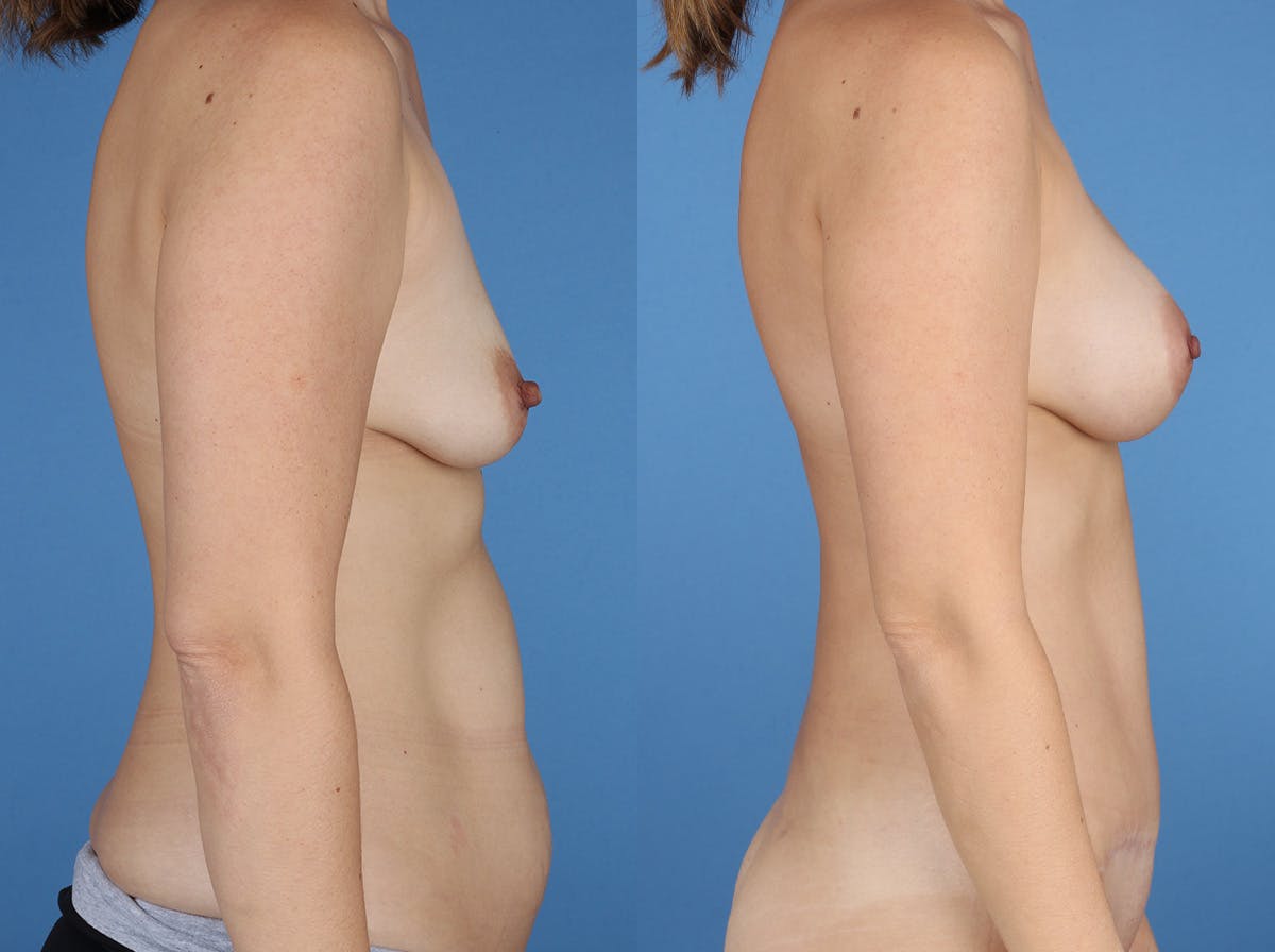 Mommy Makeover Before & After Gallery - Patient 273555 - Image 3