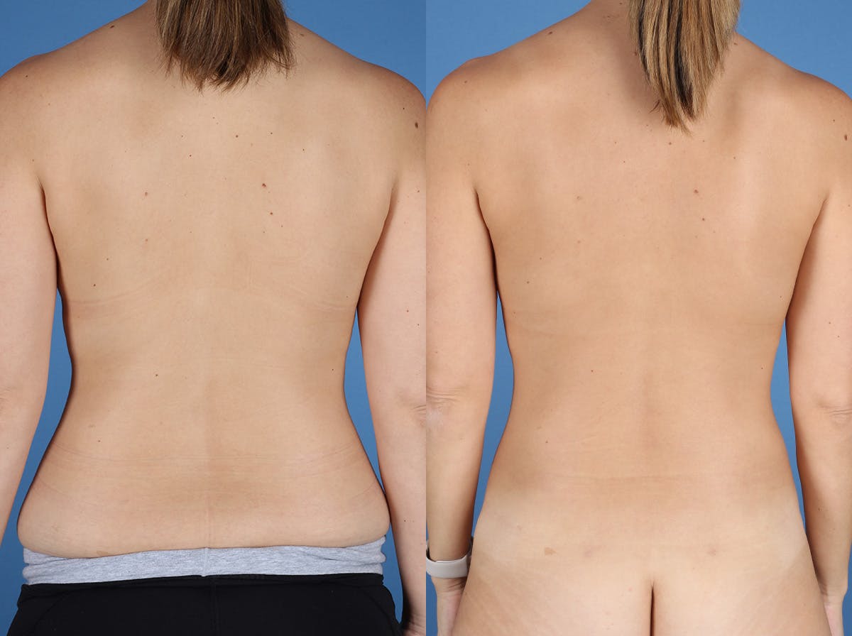 Mommy Makeover Before & After Gallery - Patient 273555 - Image 4