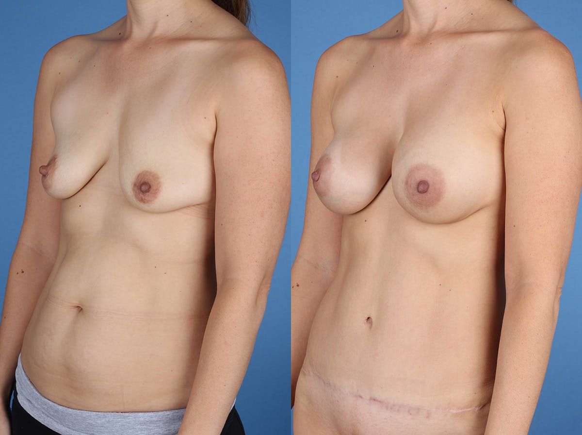 Mommy Makeover Before & After Gallery - Patient 273555 - Image 5