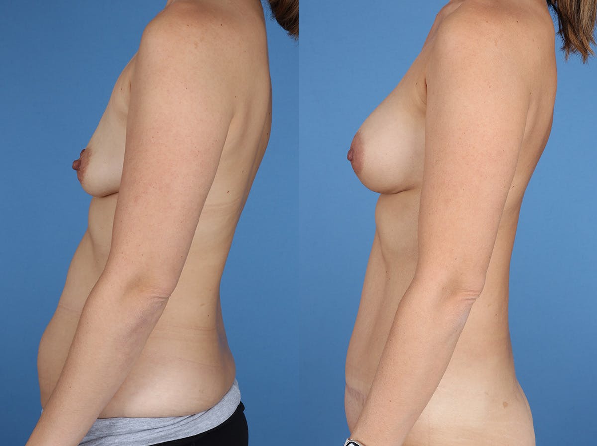 Mommy Makeover Before & After Gallery - Patient 273555 - Image 6