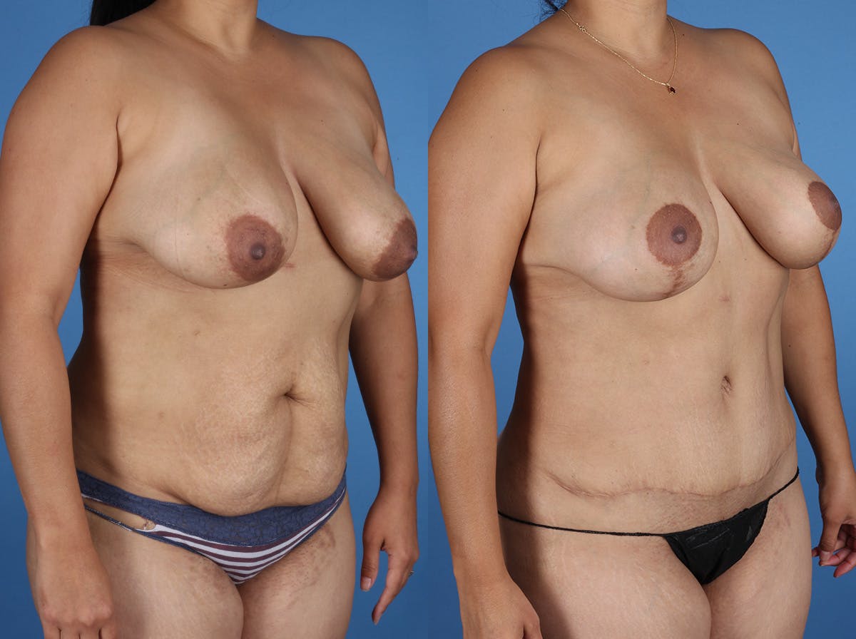 Mommy Makeover Before & After Gallery - Patient 272402 - Image 2
