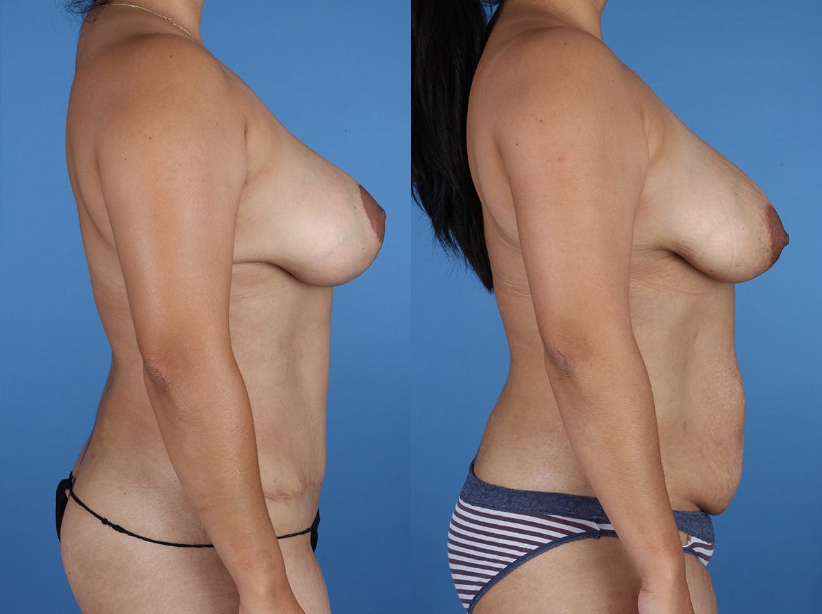 Mommy Makeover Before & After Gallery - Patient 272402 - Image 3