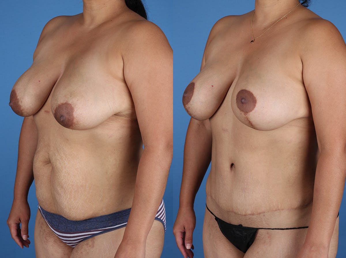 Mommy Makeover Before & After Gallery - Patient 272402 - Image 4