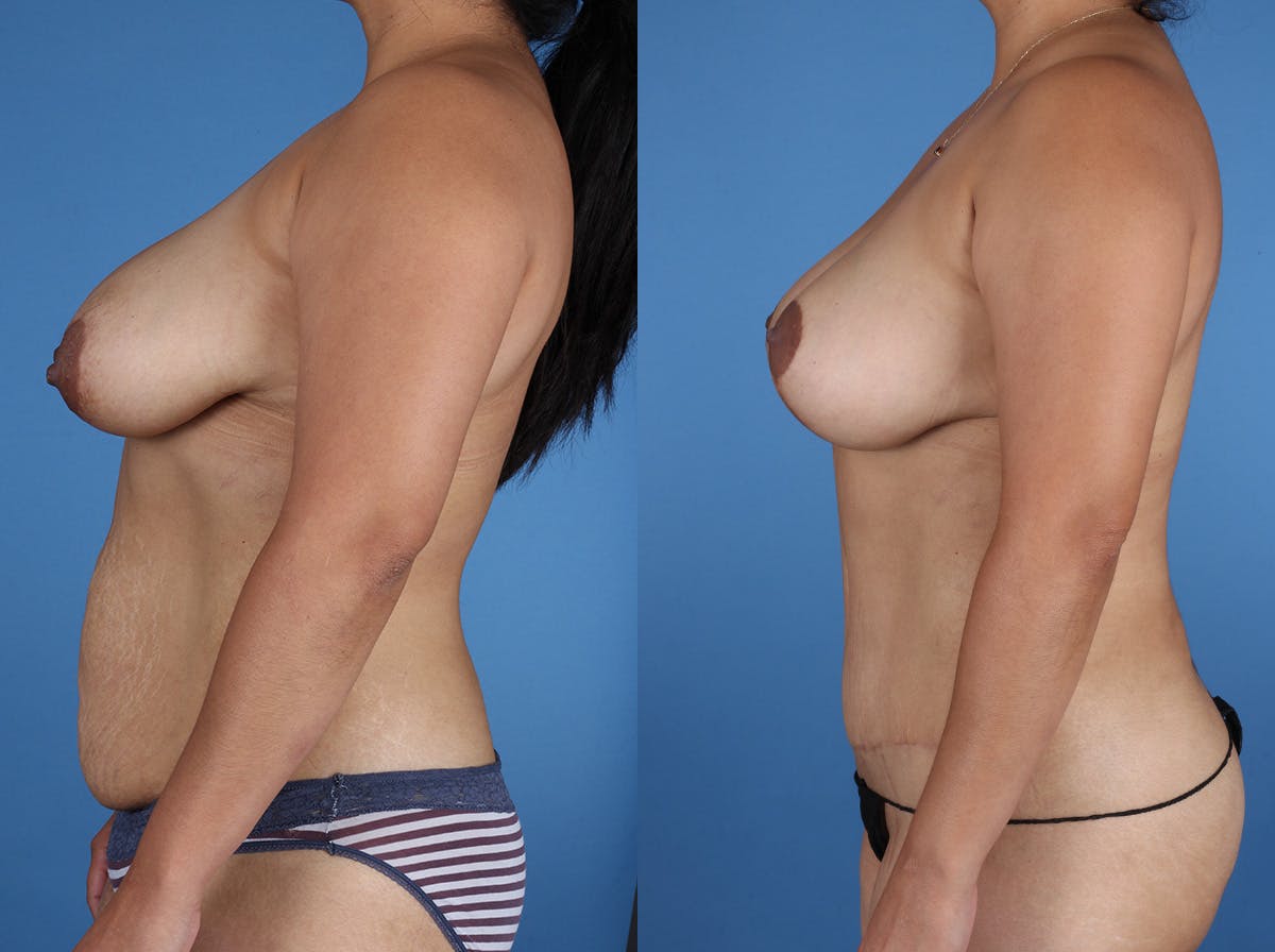 Mommy Makeover Before & After Gallery - Patient 272402 - Image 5