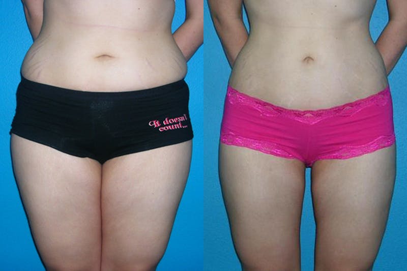 Abdominal High-Definition Liposuction Before & After Gallery - Patient 123205 - Image 1