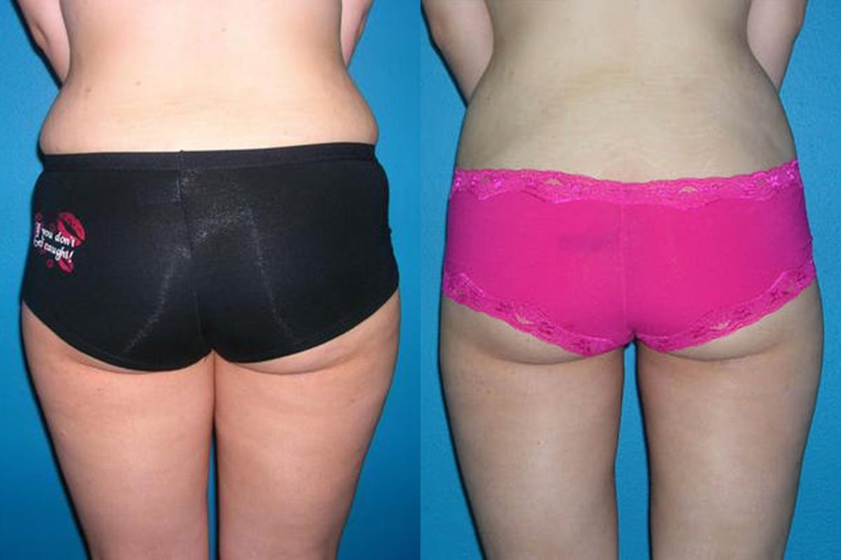 Abdominal High-Definition Liposuction Before & After Gallery - Patient 123205 - Image 2