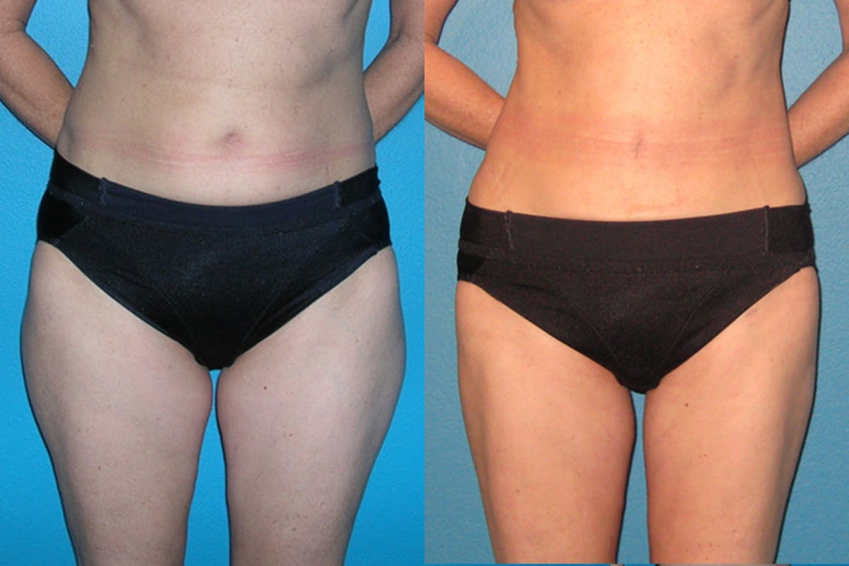 Abdominal High-Definition Liposuction Before & After Gallery - Patient 155880 - Image 1
