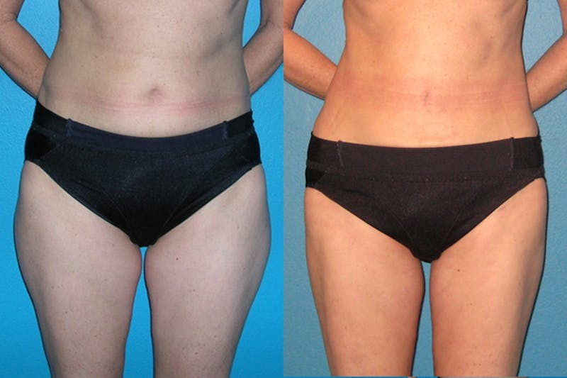 Abdominal High-Definition Liposuction Before & After Gallery - Patient 155880 - Image 1