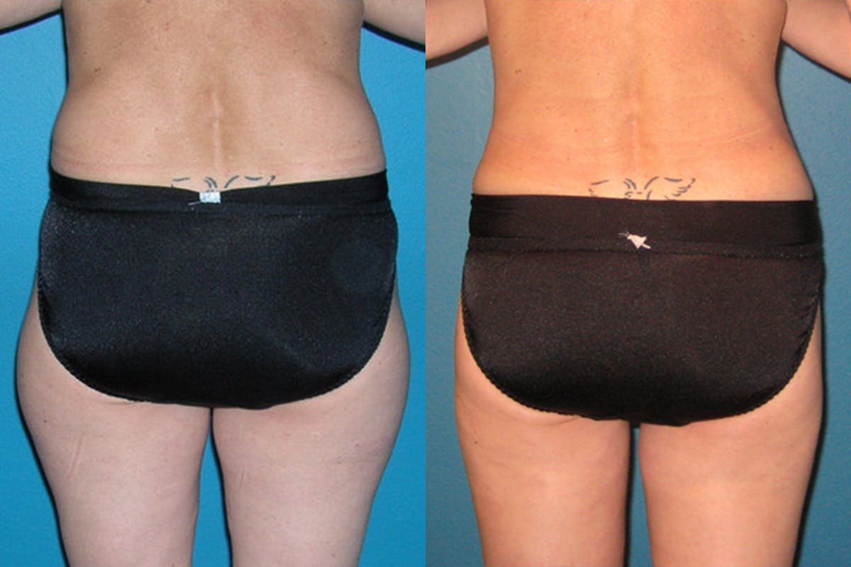 Abdominal High-Definition Liposuction Before & After Gallery - Patient 155880 - Image 2