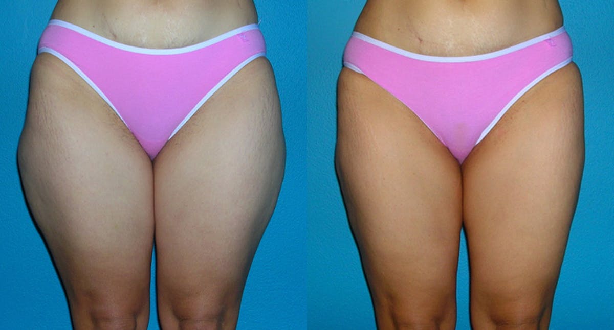 Abdominal High-Definition Liposuction Before & After Gallery - Patient 486696 - Image 1